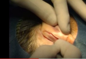 Intervencióbn o cirugia de orejas u otoplastia