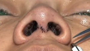Cirugía de nariz o rinoplastia