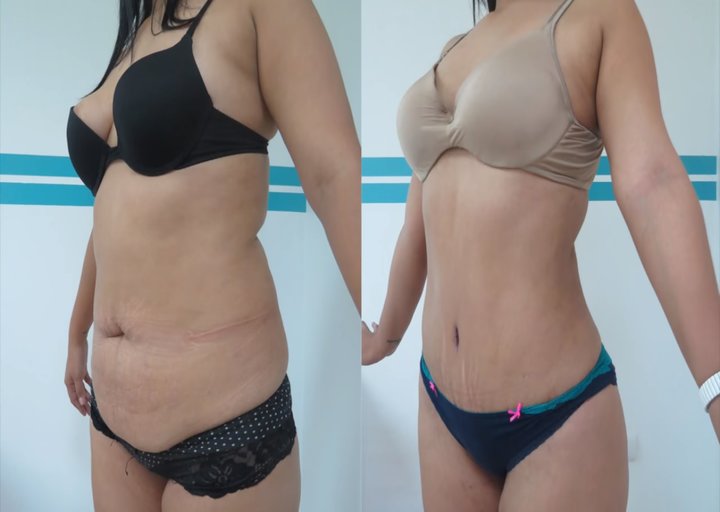 Recuperación de la abdominoplastia paso a paso - Cirugia Martinez