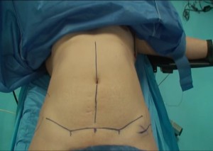 Cirugia abdominoplastia