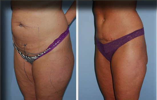 mesotherapy before and after, overweight stomach, online, telemedicine