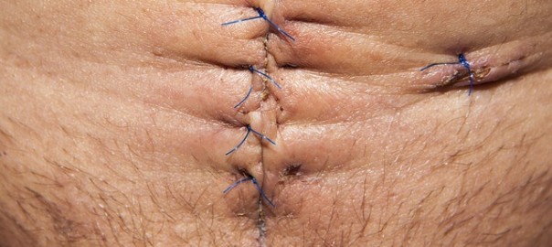 Suturas de cirugía de abdomen. Consejos de recuperación de abdominoplastia
