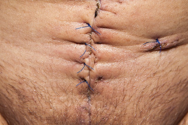 Suturas de cirugía de abdomen. Consejos de recuperación de abdominoplastia